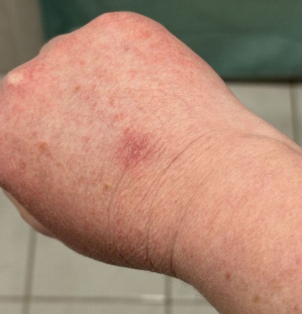 Chemo dead spot