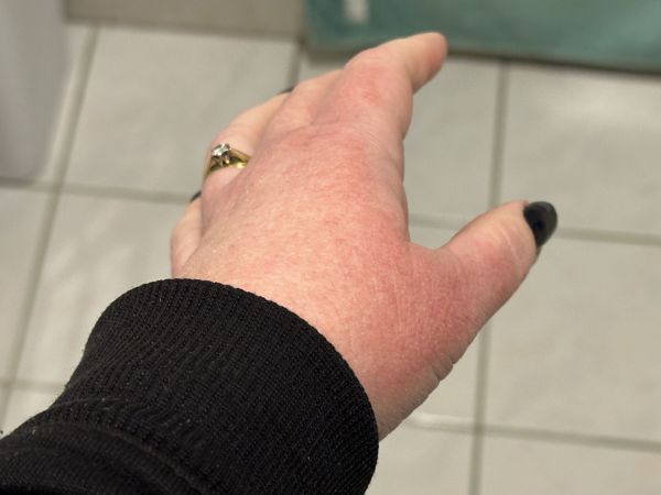 Left hand rash