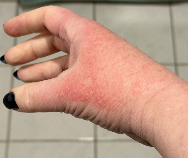 Right hand rash