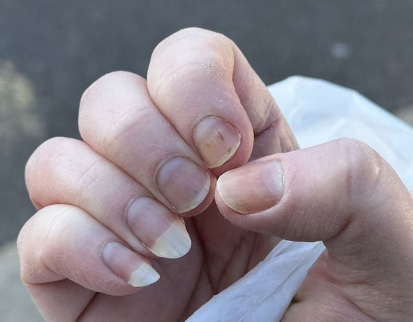 Fingernails