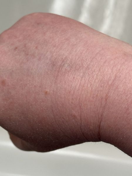 Chemo burn