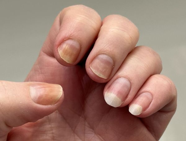 Fingernails