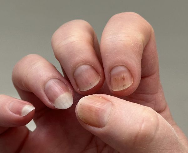 Fingernails