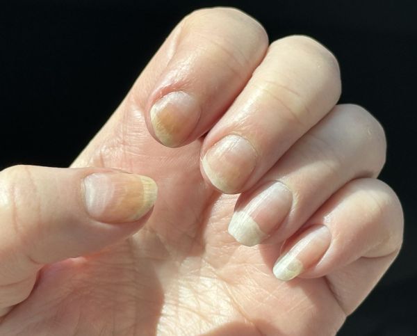 Fingernails