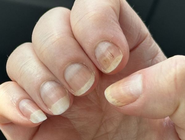 Fingernails