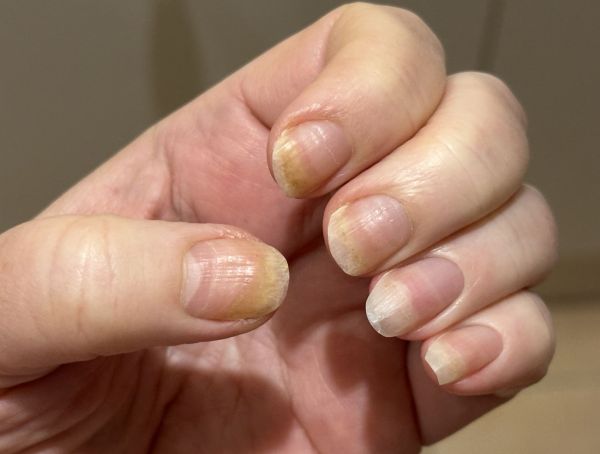 Fingernails