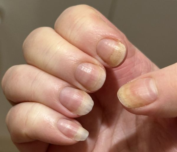Fingernails