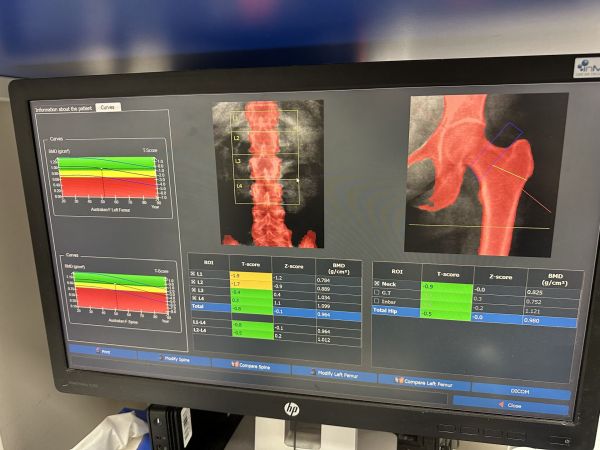 Bone density scan